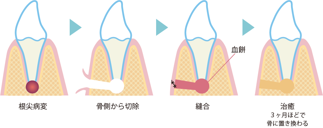 歯根端切除術の流れ