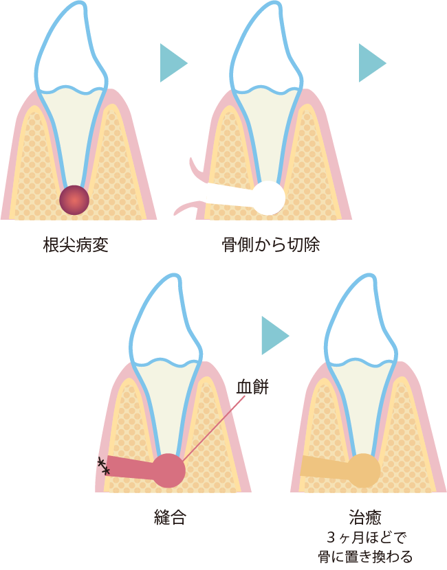 歯根端切除術の流れ